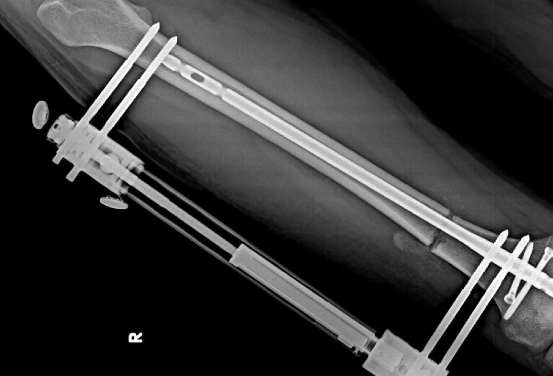 Intramedullar Nail Intramedullar Nail